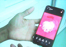 Người đàn ông xổ ra ngoài con sán xơ mít dài 9m