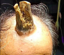 Lão nông 74 tuổi 'mọc sừng quỷ' trên đầu