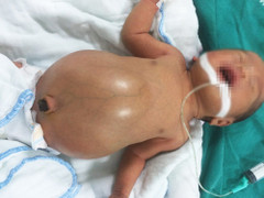 Cứu sống bé trai 2 ngày tuổi bị tắc ruột bẩm sinh