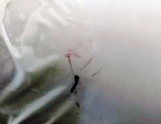 Bác sĩ gắp con vắt trong mắt bé gái 5 tuổi