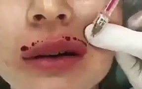Cô gái trẻ bị hoại tử nặng vùng mặt do mua chất làm đầy mua trên mạng