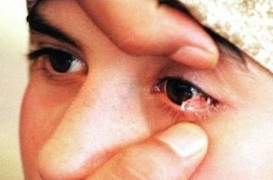 Cô gái chịu đau đớn khi hàng ngày khóc ra 50 mảnh pha lê thay vì nước mắt