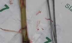 Lấy thành công dị vật dài 20cm đâm xuyên da bụng bé trai ở Hà Tĩnh