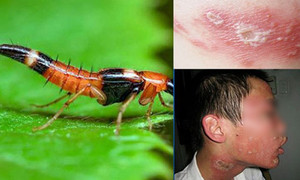 Mưa nhiều, kiến ba khoang phát triển và tấn công người dân