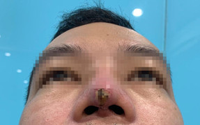 Làm đẹp ở spa, chàng trai suýt mất mũi, lộ thanh silicone