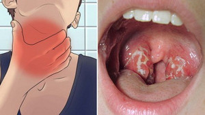 Quảng Nam: Điều trị cách ly một học sinh nghi mắc bệnh bạch hầu