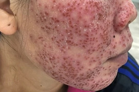 Lột da bằng vi tảo biển, mặt cô gái bong tróc đáng sợ