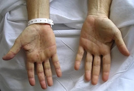 Con chào đời bị giang mai, mẹ mới biết mắc bệnh