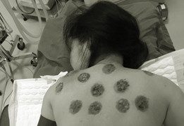 Đi giác hơi cải thiện sức khỏe, người phụ nữ hoại tử cả lưng