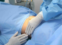 Hút mỡ bụng tại thẩm mỹ viện, người phụ nữ nhập viện cấp cứu