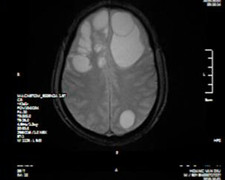 Ổ sán khổng lồ 'lúc nhúc' trong não người đàn ông ở Phú Thọ