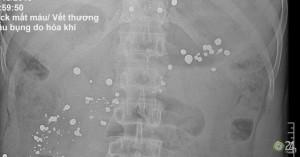 Cứu sống người đàn ông bị đạn súng tự chế bắn thủng dạ dày