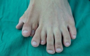 Chàng trai 21 tuổi có 9 ngón trên một bàn chân