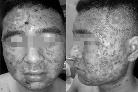 Mua thuốc trị mụn trên Facebook, nam thanh niên bị mưng mủ khắp mặt