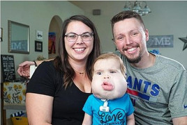 Nghị lực sống của cậu bé 18 tháng tuổi có 'khuôn mặt khác người'