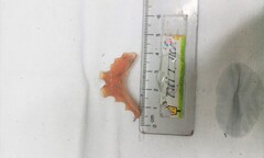 Người phụ nữ nuốt phải răng giả khi uống thuốc
