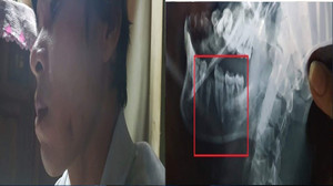 Tự ý sửa nhà trên đất tranh chấp, còn rủ người ném đá vỡ quai hàm hàng xóm