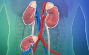 Người phụ nữ có 3 quả thận, đồng ý tặng một quả