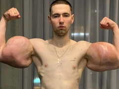 Tiêm dầu vào tay để cải thiện cơ bắp, nam thanh niên suýt chết