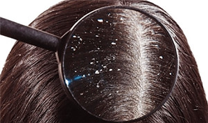 Mách bạn mẹo đơn giản để ngăn gàu trong mùa đông