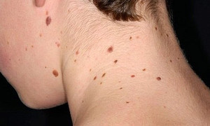 Đâu là thủ phạm gây ung thư da?