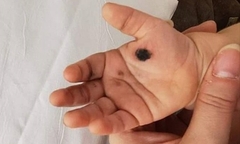 Nghịch sạc điện thoại, bé gái 3 tuổi bị giật tung người và cháy tay