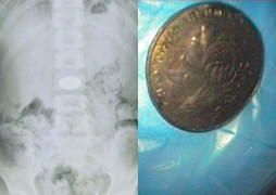 Cậu bé 8 tuổi nuốt đồng xu vào bụng để trốn làm bài tập về nhà