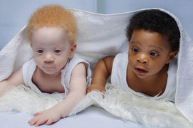 Video: Cặp sinh đôi một da đen, một da trắng hiếm gặp