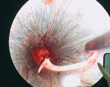 Suýt mất mạng vì uống 'nước thần' chữa hóc xương cá