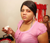 Vì sao ngày càng nhiều người mắc bệnh đổ mồ hôi máu cực kỳ nguy hiểm?