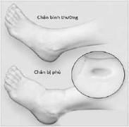 Mắc các dấu hiệu này, nguy cơ suy tim sớm