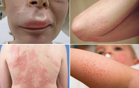 Tối nay gió mùa về, cẩn thận với chứng dị ứng thời tiết 'chết người'