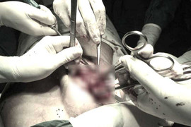 Bà mẹ trẻ xập xệ vì bơm silicon 'chui'