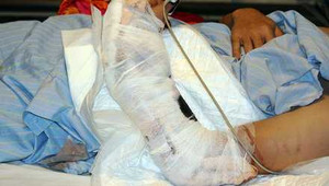 Nghịch sạc điện, bé trai 3 tuổi mất tay và mắt do vật gây nổ