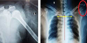 Đi bộ, bị đuôi xe tải đập gãy xương bả vai dạng hiếm gặp