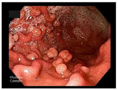 Bị polyp đại trực tràng tuyến, 100% sẽ mắc ung thư sau tuổi 40