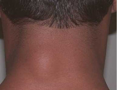 Vì sao nhiều người bỗng dưng mọc bướu mỡ?