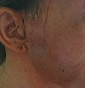 Thiếu phụ Sài Gòn nhiễm trùng máu vì bơm chất xóa nếp nhăn đón Tết