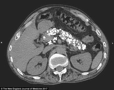 Hậu quả đáng sợ sau 15 năm uống rượu liên tục