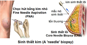 6 xét nghiệm giúp phát hiện sớm ung thư