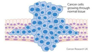 10 cách 'né' ung thư