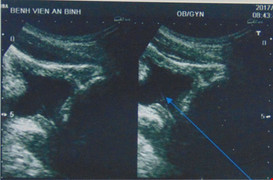 Bệnh nhân tự lấy sỏi thận qua đường niệu bằng cọng cỏ khiến bác sỹ kinh ngạc