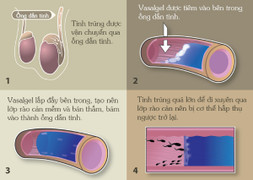 Phát minh kỳ diệu: Loại thuốc giúp đàn ông tránh thai trong 2 năm