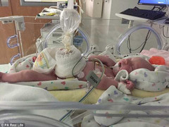 Em bé sinh ra với dạ dày, ruột, buồng trứng nằm ngoài bụng