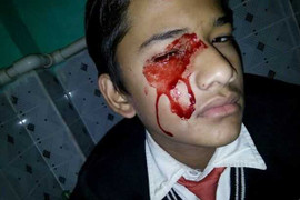 Cậu bé mắc bệnh toàn thân chảy ra máu