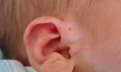 Sưng nửa mặt chỉ vì lỗ hở bằng đầu tăm ở tai