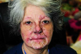 Người phụ nữ mắc bệnh sợ mặt trời hơn sợ ma