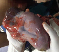 Nghệ An: Sản phụ sinh con lần thứ 7 còn nguyên túi ối