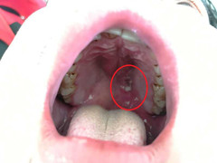 Dùng miệng thổi nòng súng, đạn găm vào vòm họng suýt chết