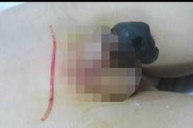 Hy hữu: Bé trai nghịch dây thun bị hoại tử 'của quý'